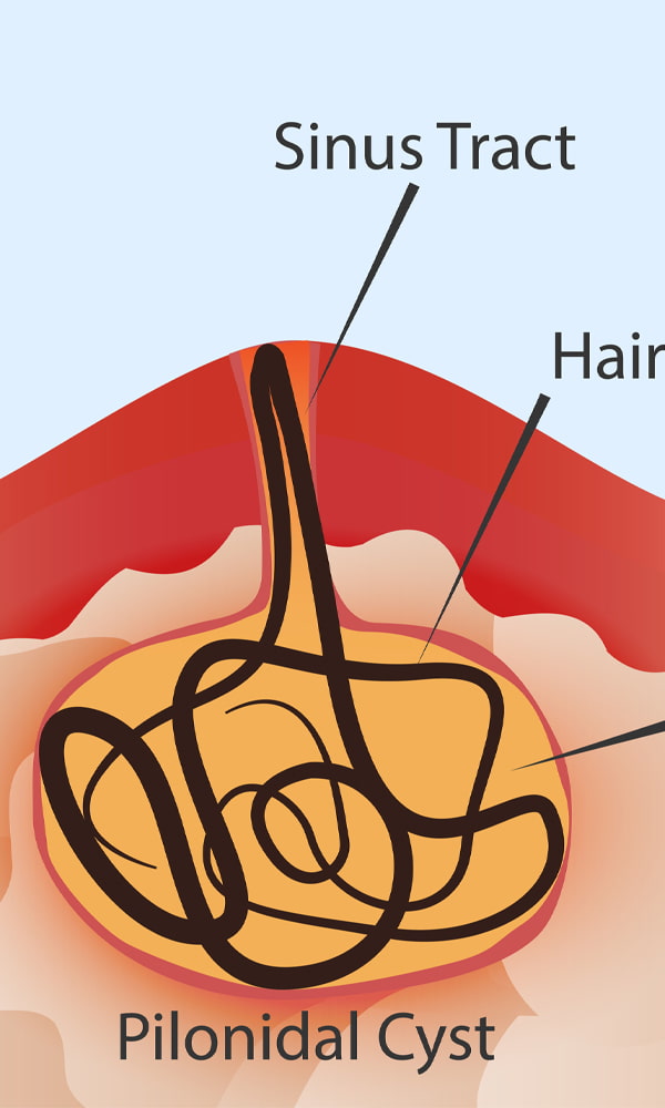 What is Pilonidal Disease? - Pilonidal Treatment Center of New Jersey