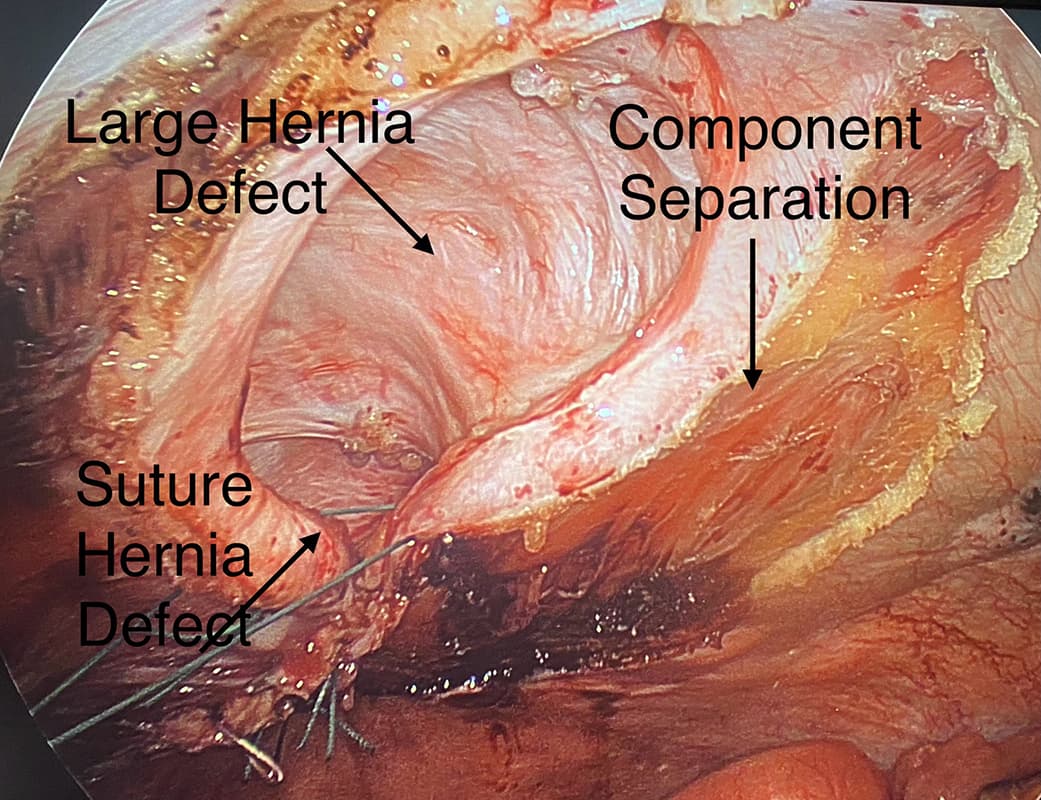 real incisional hernia patient | Advanced Surgery NJ